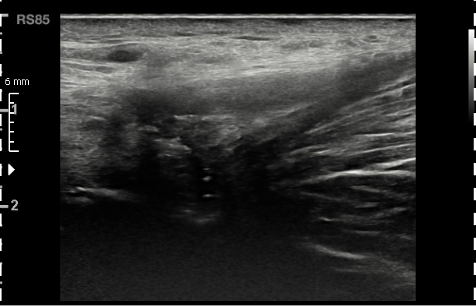 Déchirure du tendon fig.04